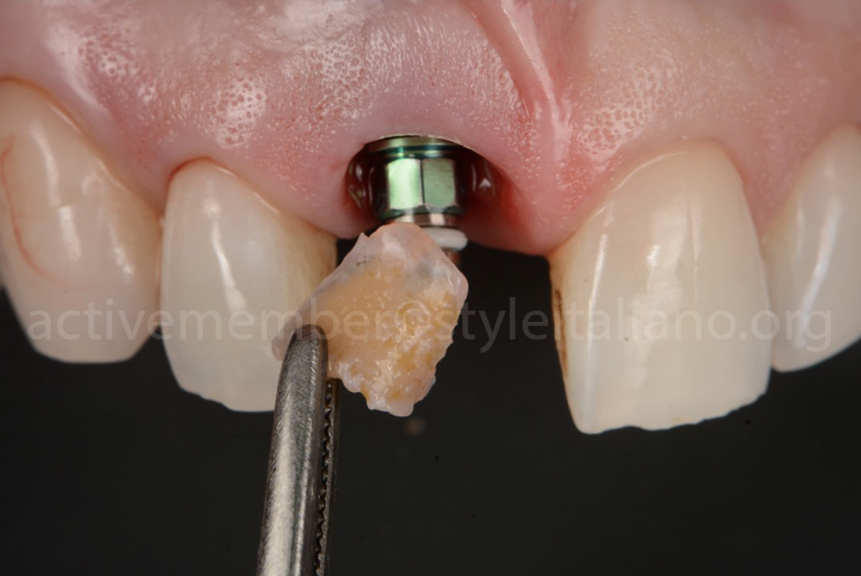 Phục hình thẩm mỹ răng cửa bằng sự kết hợp giữa Veneer và implant